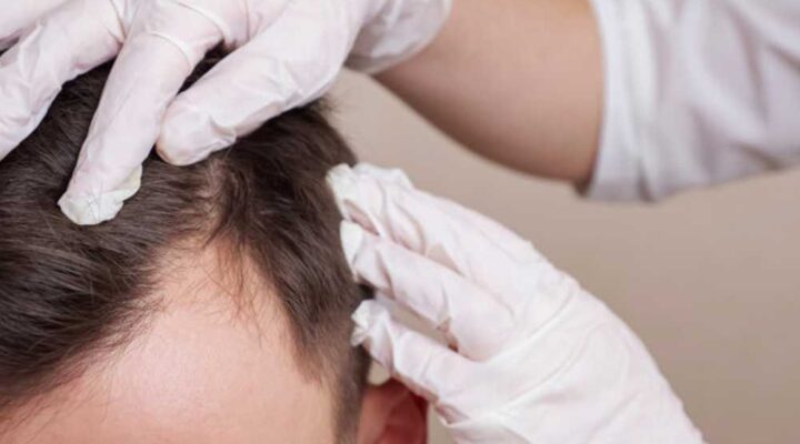 أفضل عملية زراعة الشعر