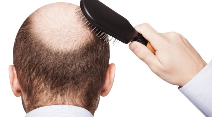 زراعة الشعر من شخص آخر