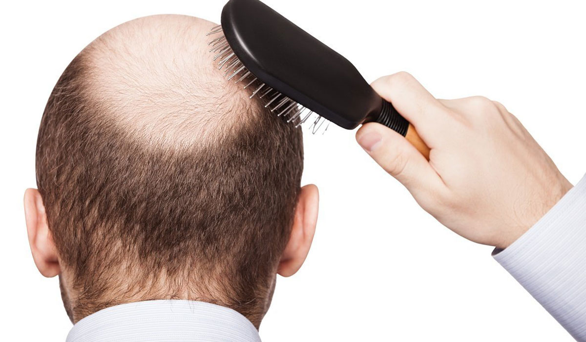 زراعة الشعر من شخص آخر