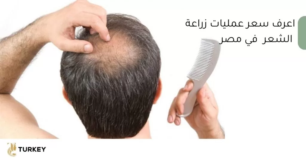 ثمن عمليات زراعة الشعر