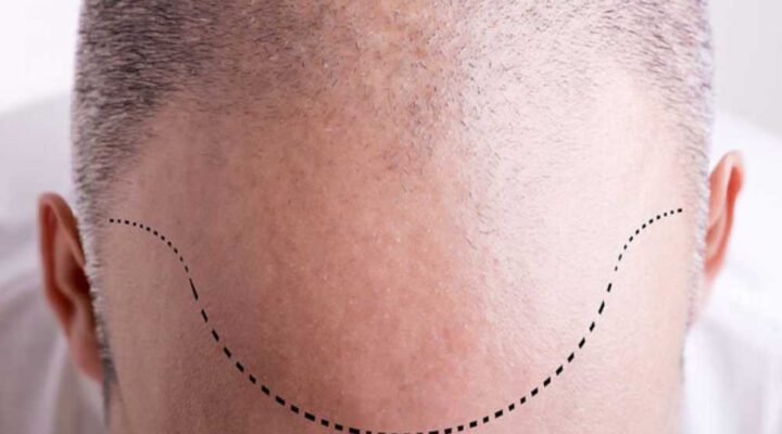 طرق زراعة الشعر