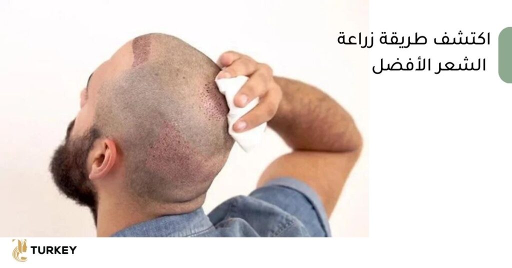 طريقة زرع الشعر