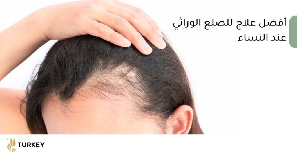 الحل النهائي لـ علاج الصلع الوراثي للنساء 3 علاج الصلع الوراثي عند النساء