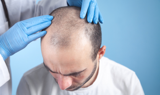 طريقة زراعة الشعر