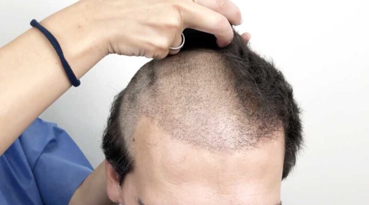 مضاعفات عملية زراعة الشعر