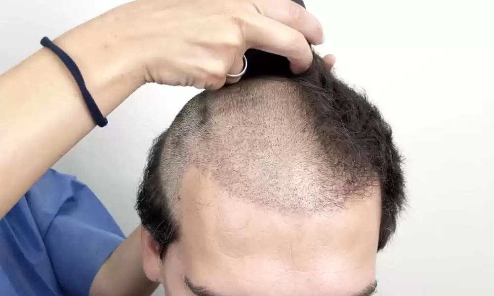 مضاعفات عملية زراعة الشعر