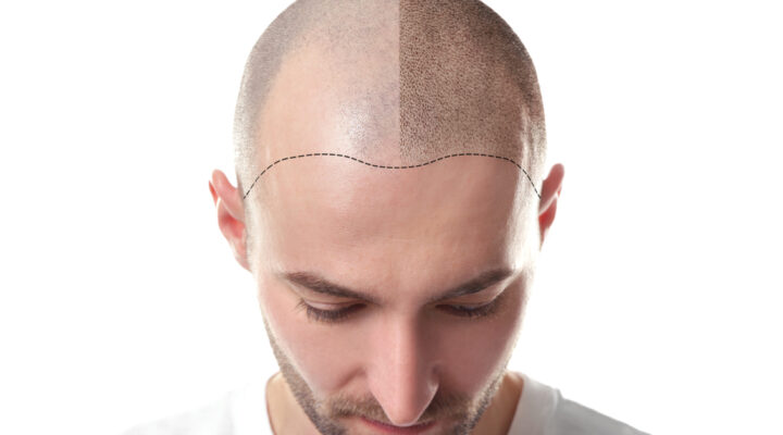 القشور بعد عملية زراعة الشعر