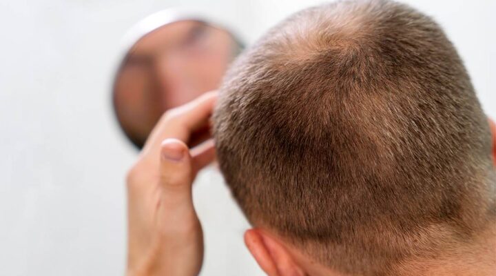المنطقة المانحة بعد زراعة الشعر