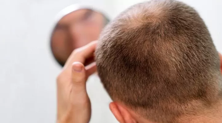 المنطقة المانحة بعد زراعة الشعر