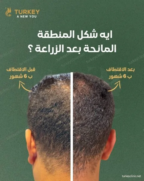 متي تتعافي المنطقة المانحة بعد زراعة الشعر؟ وأهم طرق التعافي 2 المنطقة المانحة بعد عملية زراعة الشعر
