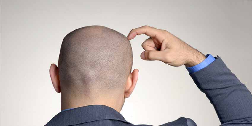 متى يكون تساقط الشعر بعد الزراعة خطرًا
