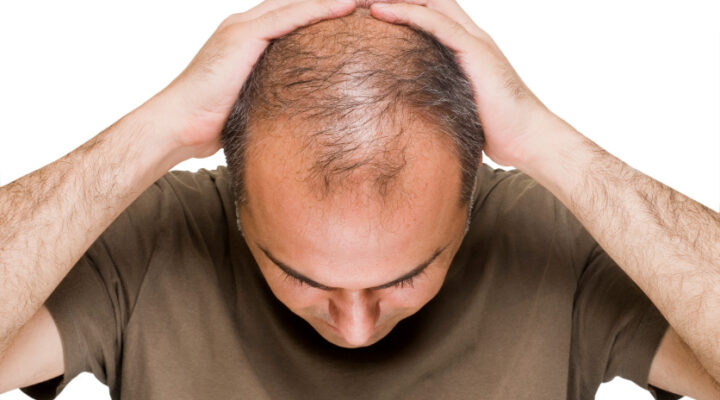 متى يمكن تغطية الرأس بعد زراعة الشعر
