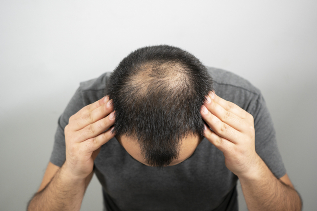 سعر زراعة الشعر