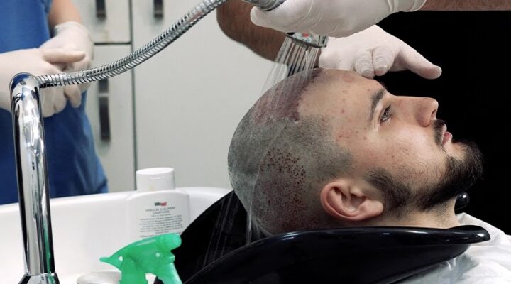 كيف يتم رش المحلول بعد زراعة الشعر
