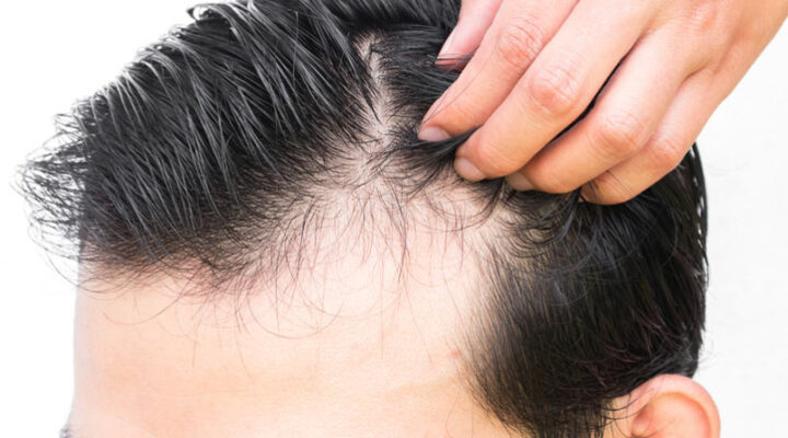 سعر عمليات زراعة الشعر