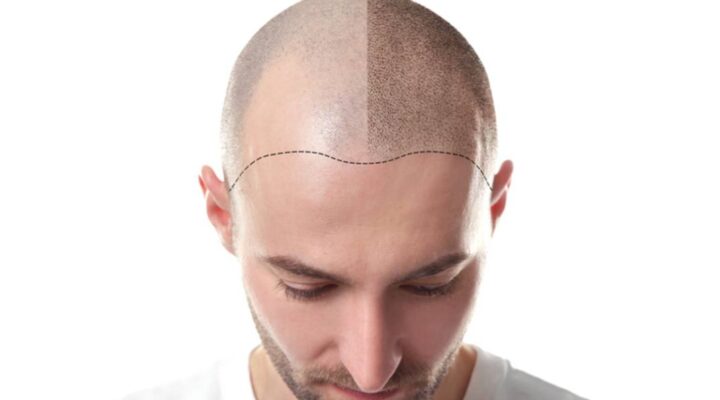 زراعة الشعر بعد شهرين