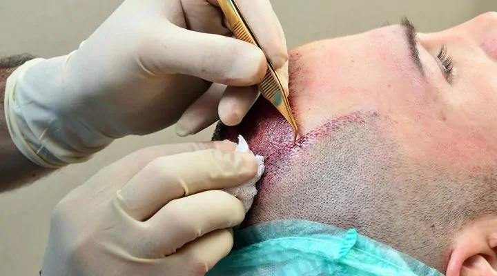 عملية زرع شعر الرأس