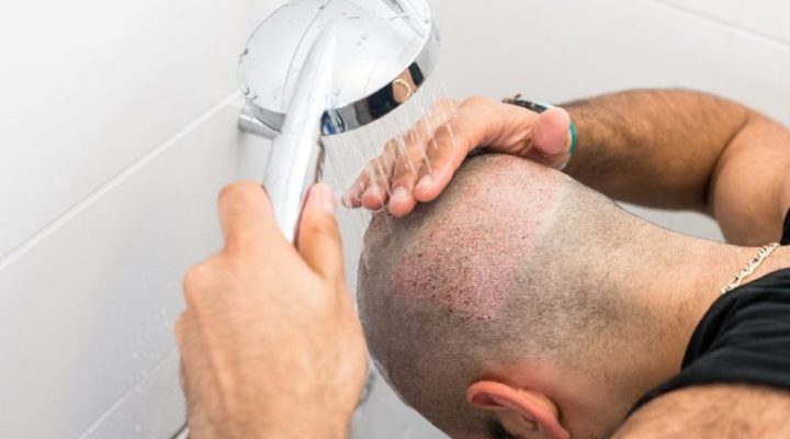 رش محلول الملح بعد زراعة الشعر