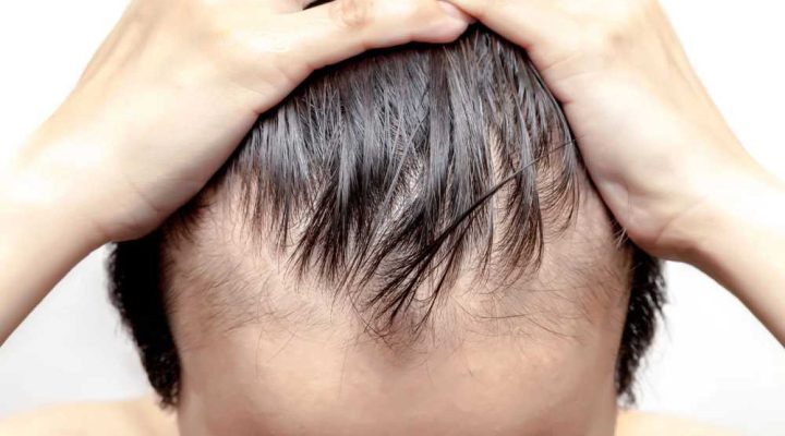زراعة شعر فاشلة