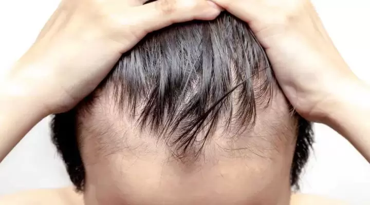 كيفية إصلاح زراعة شعر فاشلة | و5 أسباب لفشل الزراعة 2 زراعة شعر فاشلة