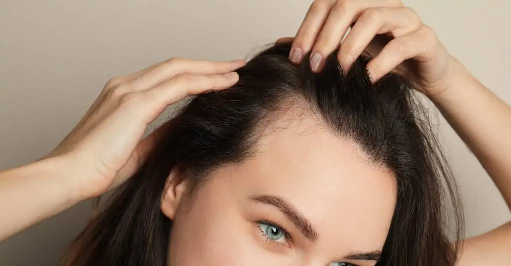 نتائج زراعة الشعر للنساء قبل وبعد ونسبة نجاح العملية 3 زراعة مقدمة الشعر للنساء