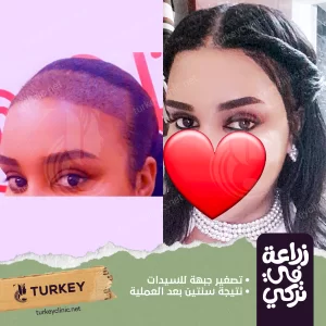 زراعة الشعر بالاقتطاف في مصر
