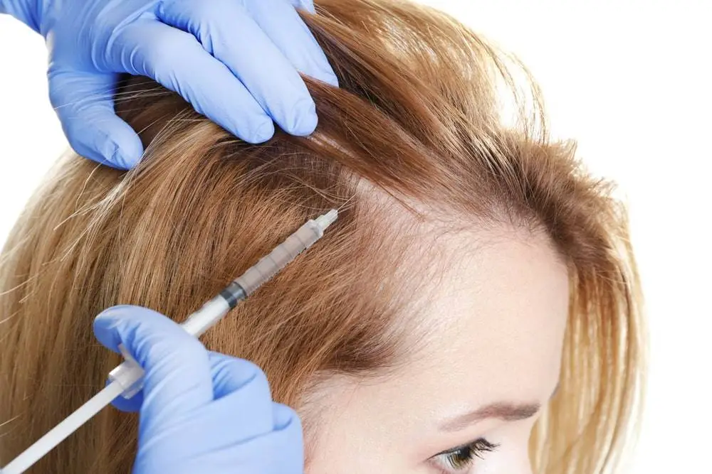 نتائج زراعة الشعر للنساء قبل وبعد ونسبة نجاح العملية 4 طريقة الاقتطاف FUE