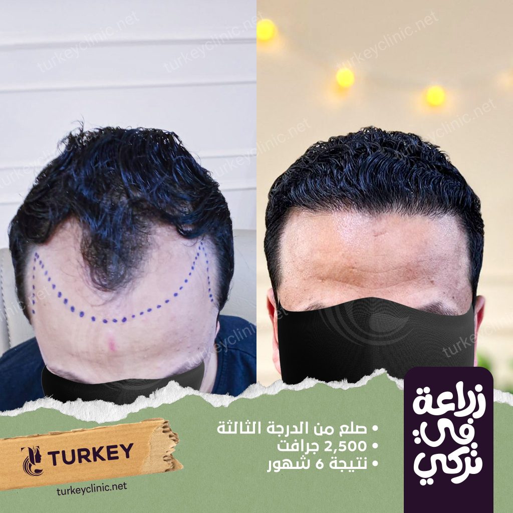 أسباب اختلاف أسعار زراعة الشعر