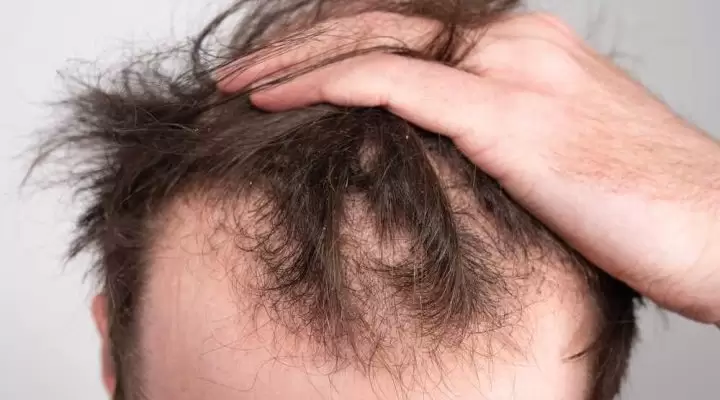 اسباب الصلع المبكر