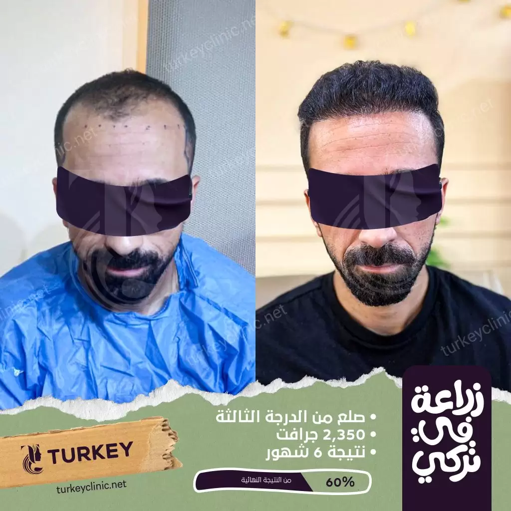 زراعة الشعر بالرياض | التقنيات والتكلفة العيوب والمميزات 2 نتائج زراعة الشعر بعد 6 أشهر