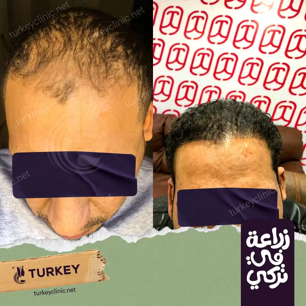 نتائج زراعة شعر بعيادات تركي هير