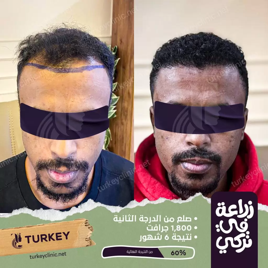 نتيجة زراعة 1800 جرافت