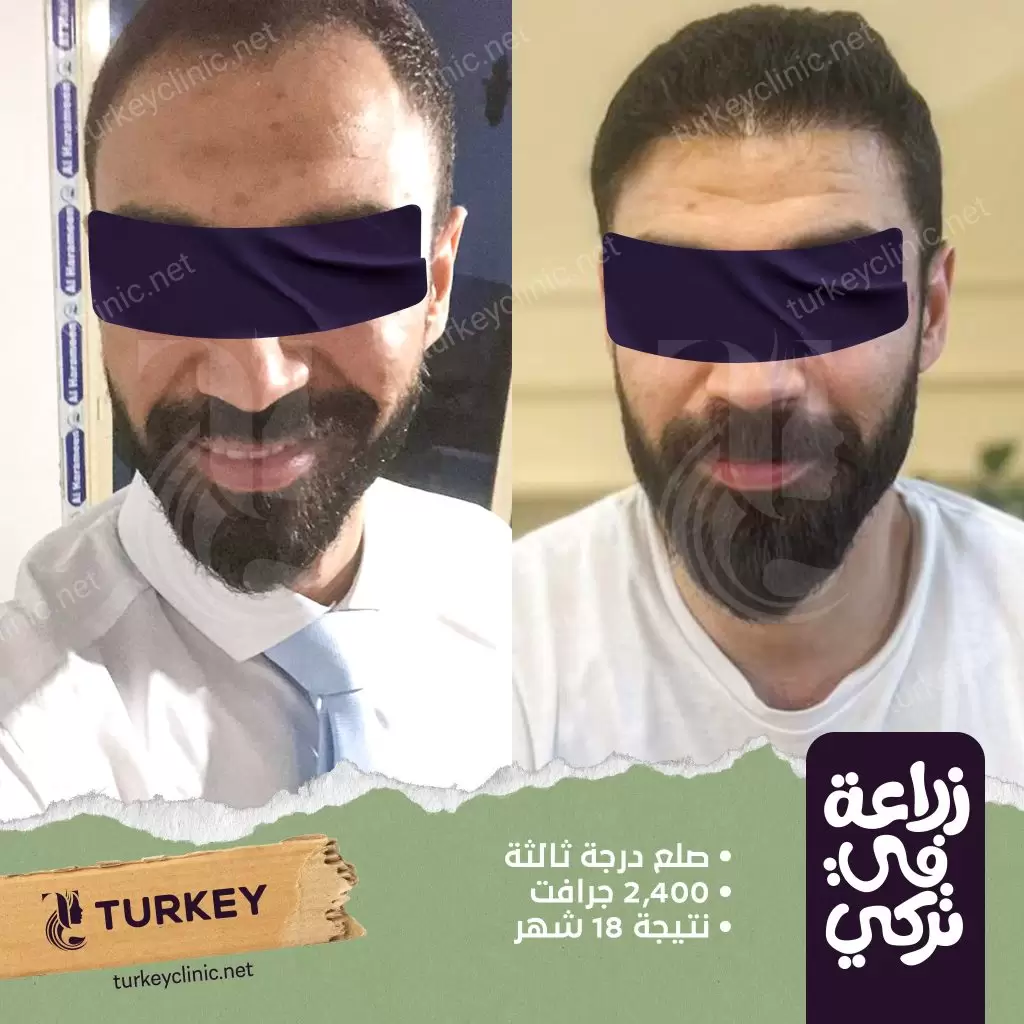 نتيجة زراعة شعر بعد 18 أشهر