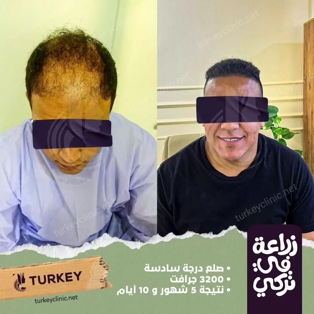 نتيجة زراعة شعر بعد 5 أشهر و5 أيام