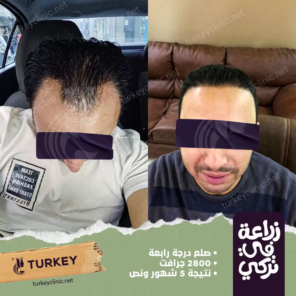 نتيجة زراعة شعر بعد 5 أشهر ونصف
