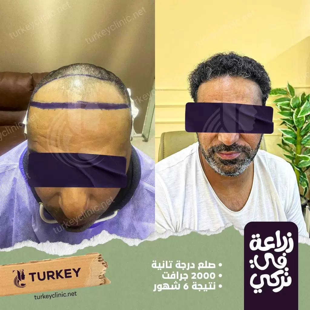 نتيجة زراعة شعر لصلع من الدرجة الثانية