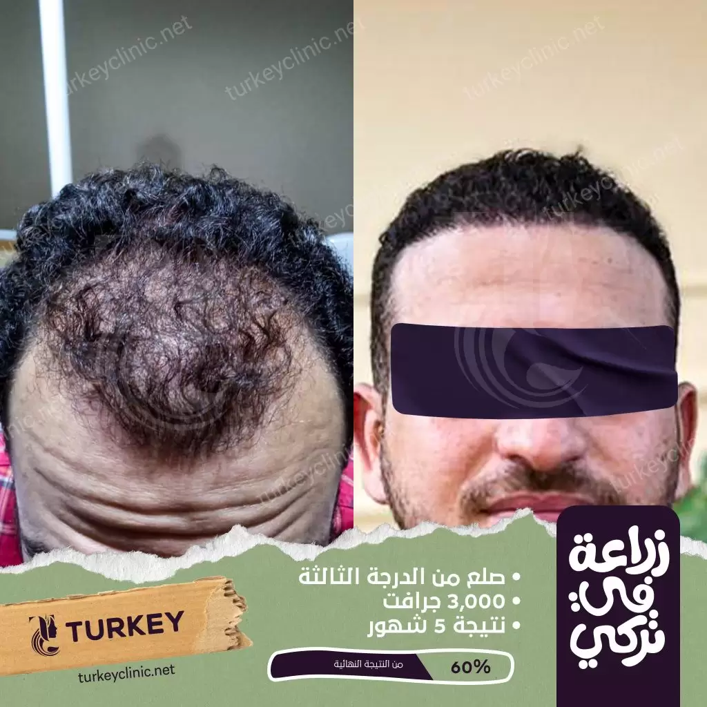 نتيجة زراعة شعر من الدرجة الثالثة