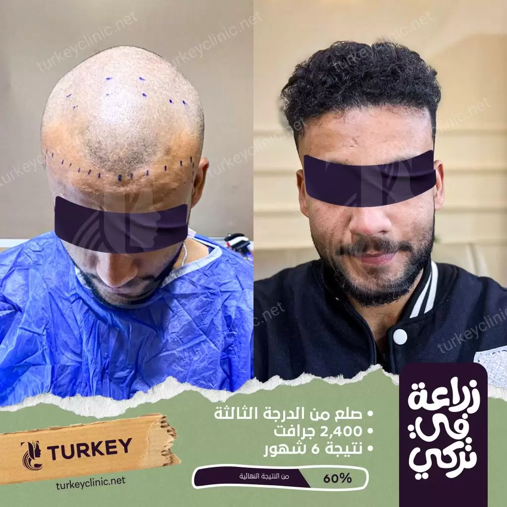 تكلفة زراعة الشعر في مصر 2025 والدول الأخرى 6 نتيجة زراعة شعر من الدرجة الثالثة