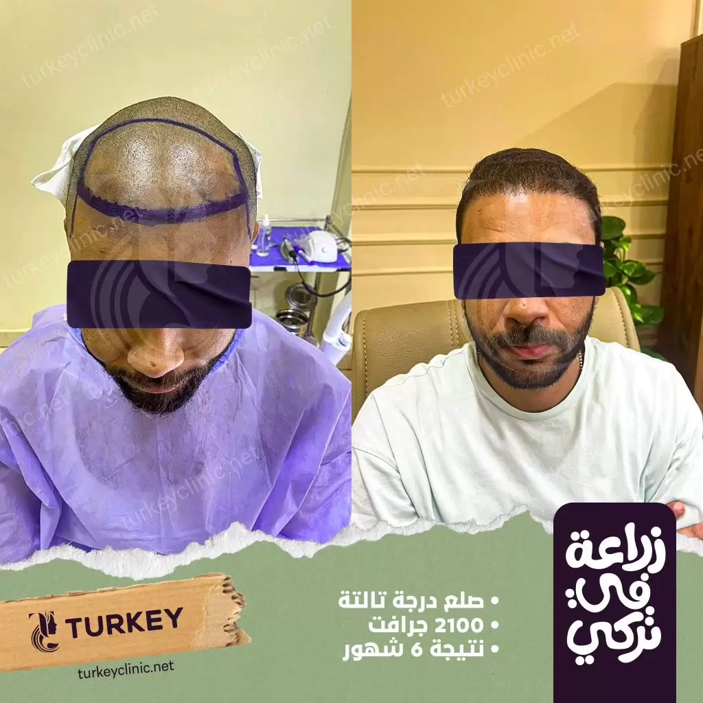 زراعة الشعر في تركيا | التقنيات والتكلفة والمميزات والعيوب 4 نتيجة زراعة صلع من الدرجة الثالثة بعيادات تركي هير
