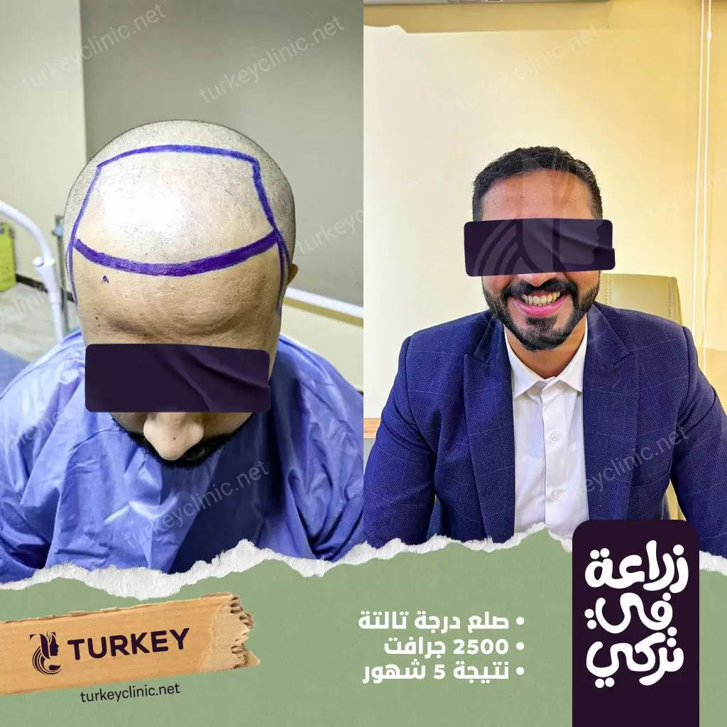 زراعة الشعر في تركيا | التقنيات والتكلفة والمميزات والعيوب 5 نتيجة زرع الشعر بعد 5 أشهر