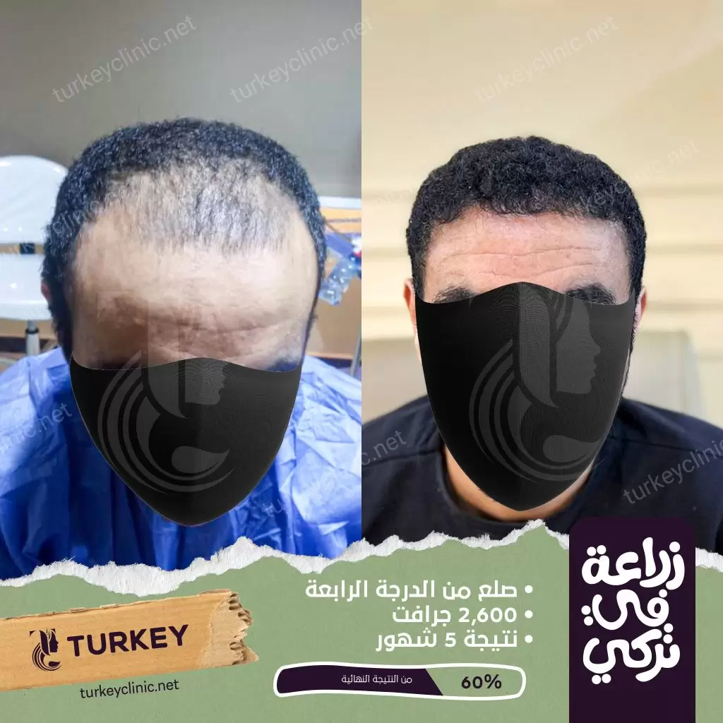 نتيجة زرع شعر بعد 5 أشهر