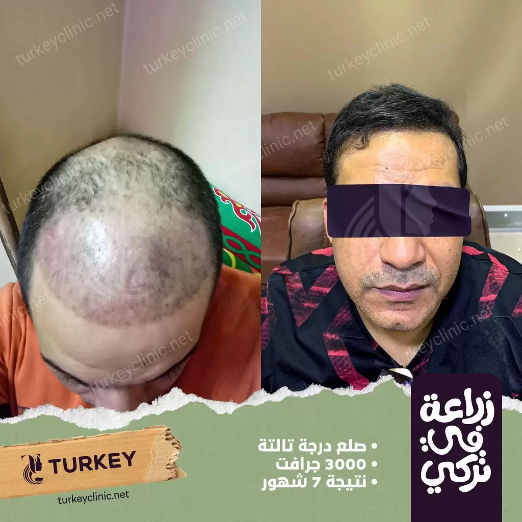 نتيجة زرع شعر بعد 7 أشهر 1