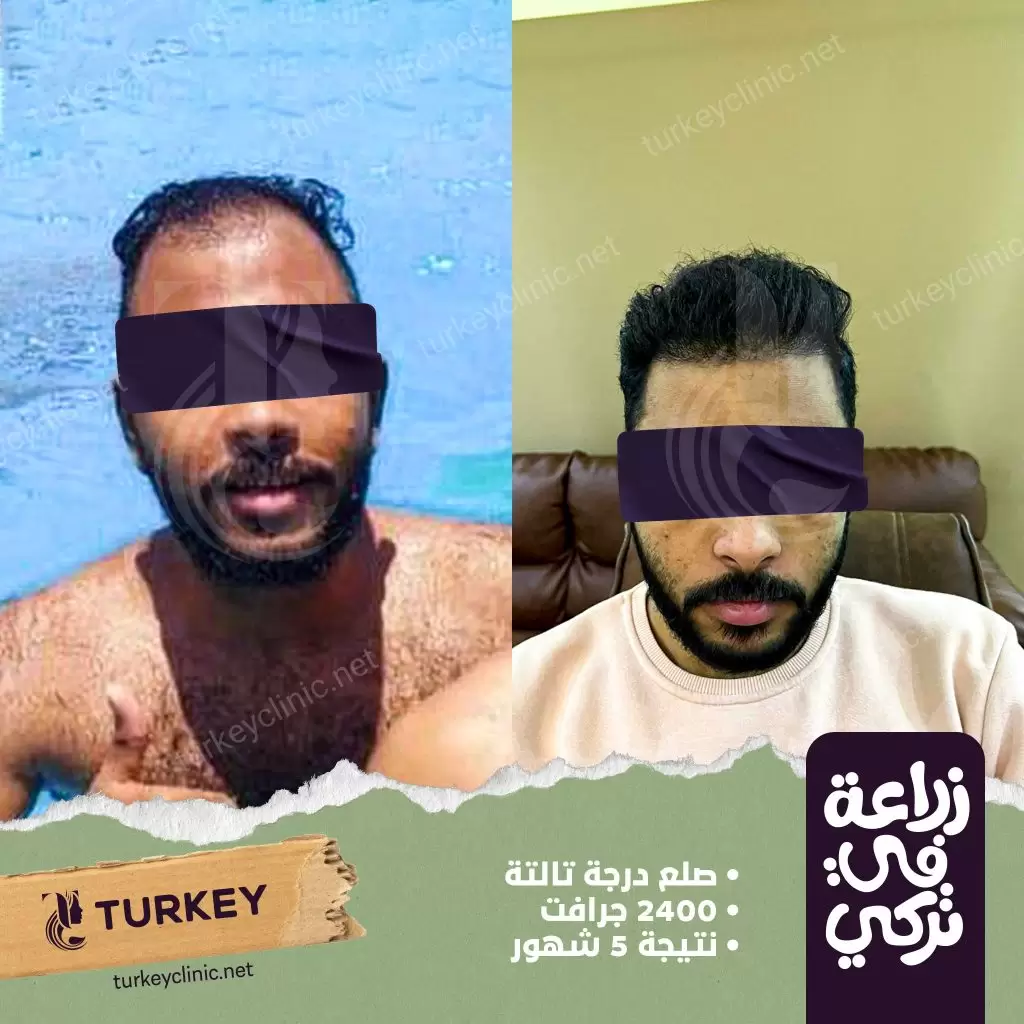 نتيجة عملية زراعة شعر بعد 5 أشهر