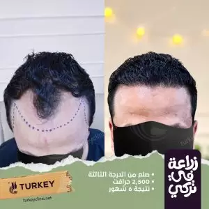 زراعة الشعر بالاقتطاف في مصر