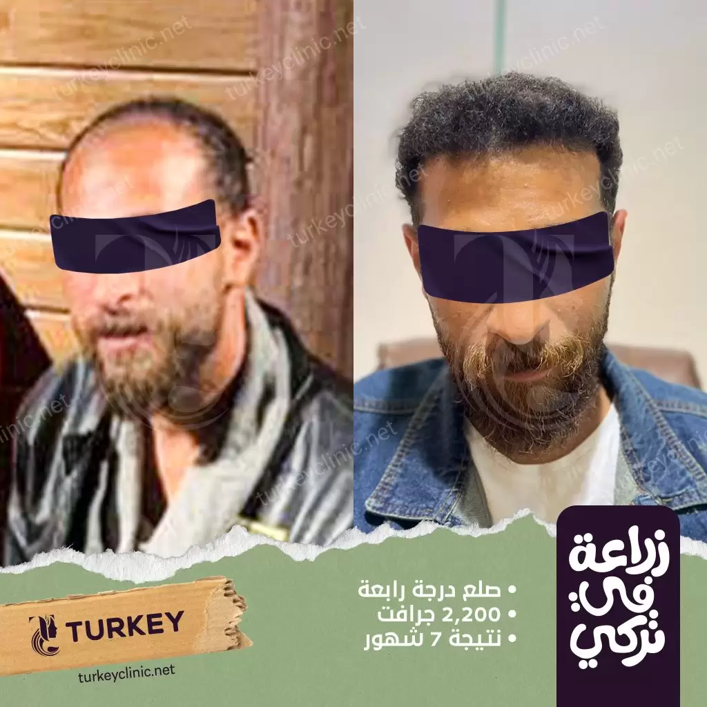 نتيجة عملية زراعة شعر من الدرجة الرابعة