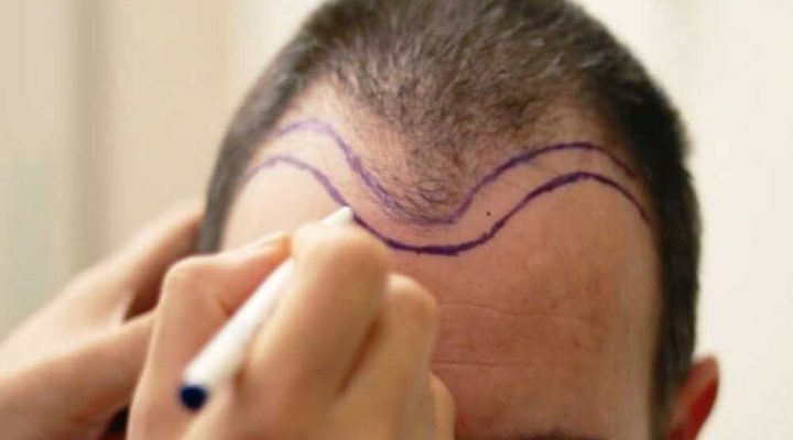 الفرق بين تقنية fue و dhi