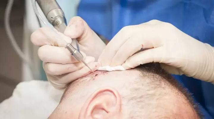 تقنية زراعة الشعر fue