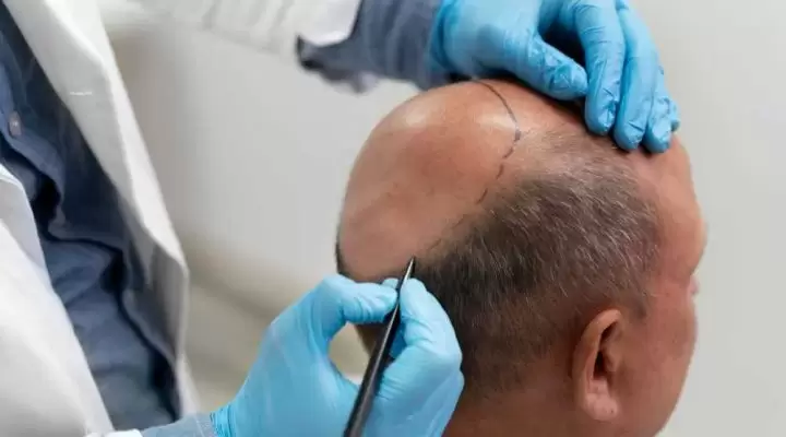 تكلفة زراعة الشعر بالاقتطاف في مصر