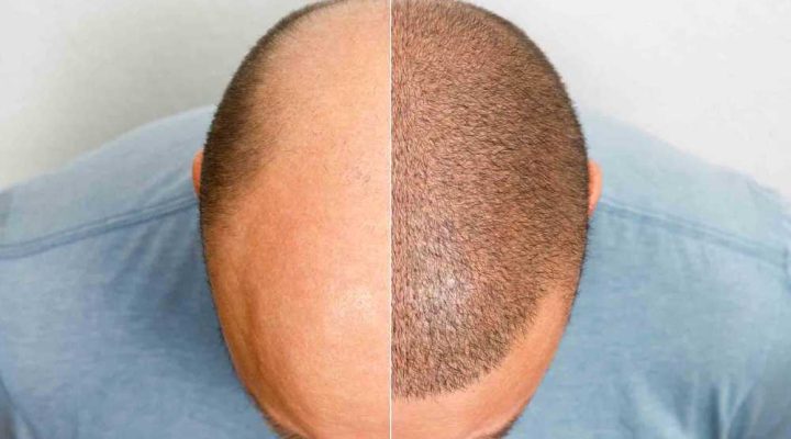 زراعة الشعر بالاقتطاف في مصر