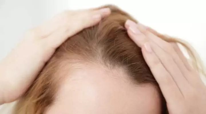 زراعة الشعر بالاقتطاف للنساء